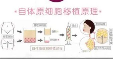 北京301医院韩岩怎么样？技术好吗？面部脂肪填充实例分享