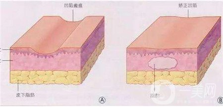 北京301医院韩岩怎么样？技术好吗？面部脂肪填充实例分享