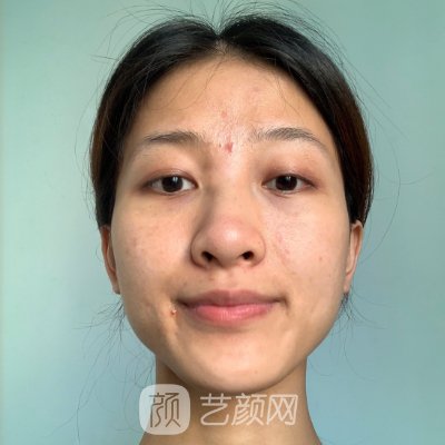 上海美星医疗美容医院隆鼻实例出炉｜附亲身体验感悟