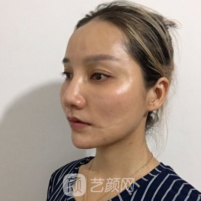 长春悦美汇整形医院做拉皮咋样？亲身体验实例出炉