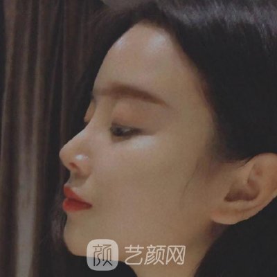 长春吉美整形医院怎么样？2022招牌隆鼻实例出炉