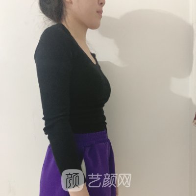 杭州黛雅陆新医生抽脂实例出炉|附体验成果图