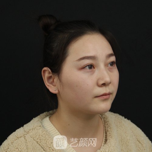 杭州艾菲医疗美容门诊部怎么样？医院招牌隆鼻实例出炉