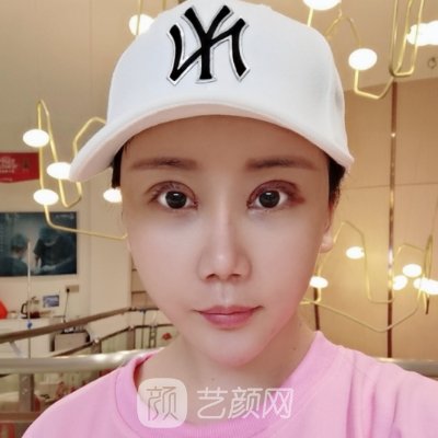 杭州西美医疗美容割双眼皮怎么样？医院招牌实例一览