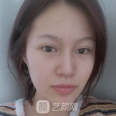 杭州艾恒美整形医院怎么样？全新双眼皮整形实例分享