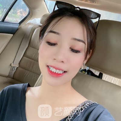 杭州优贝口腔牙齿正畸实例出炉|成果自然美观