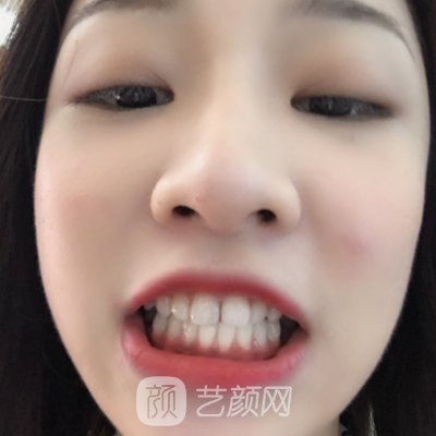 杭州优贝口腔牙齿正畸实例出炉|成果自然美观