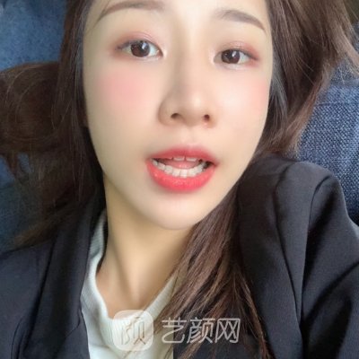 杭州优贝口腔牙齿正畸实例出炉|成果自然美观