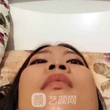 姬广翰怎么样？做鼻子好吗？医生详细介绍+隆鼻实例对比图