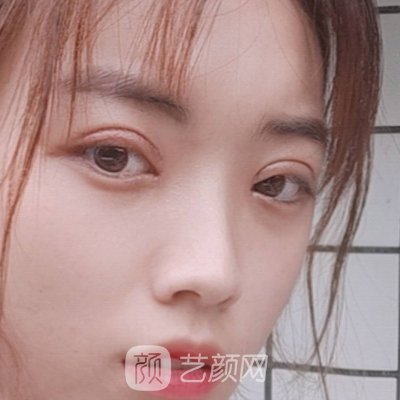 杭州芯美昕整形医院正规吗？2022双眼皮实例出炉