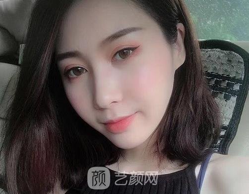 大同美神整形医院割双眼皮好不好？2022招牌实例展示