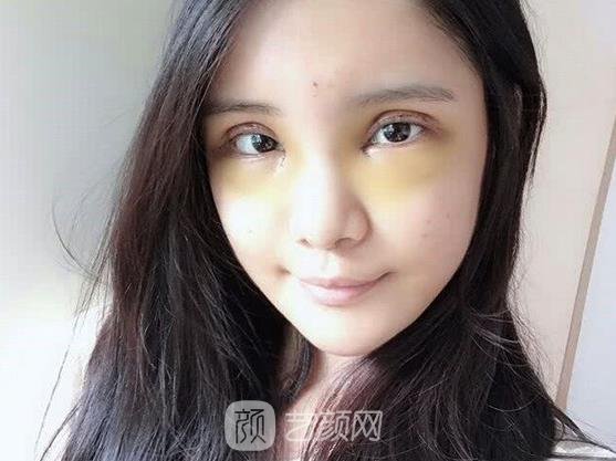 大同伊美康医疗美容诊所割双眼皮怎么样？2022全新实例一览