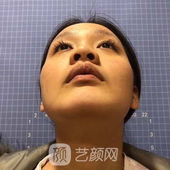 北京美莱王旭东做鼻子怎么样？收费贵不贵？隆鼻实例鉴赏