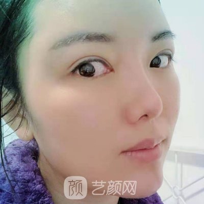 义乌阳光美容整形医院好不好？面部脂肪填充实例公布