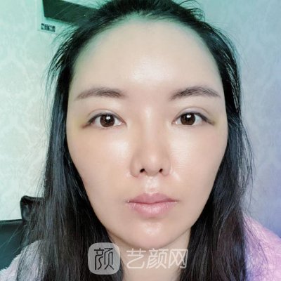 义乌阳光美容整形医院好不好？面部脂肪填充实例公布