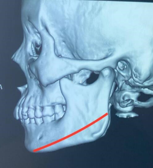 济宁医学院附属医院下颌角整形成果图展示，真人记录手术过程及术后成果~