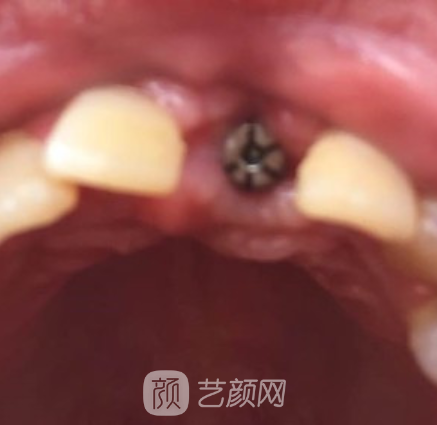 株洲优伢仕口腔医院怎么样？种植牙实例全新一览