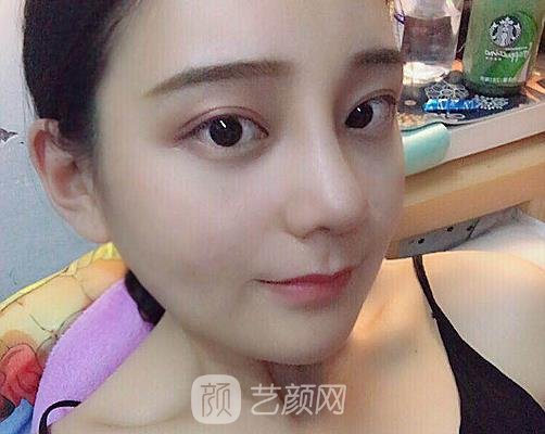 大连芳华李荣喆隆鼻实例曝光|内附体验成果图