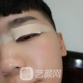 男生割双眼皮帅多了，真人实例：术后眼睛又大又深邃