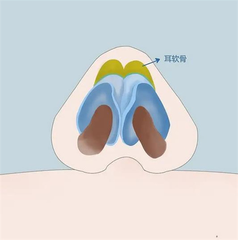 延长鼻小柱要修复多久？