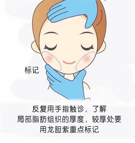 面部吸脂后会导致皮肤变松弛吗