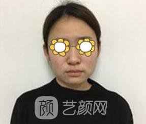 吉玟锡在上海哪家医院？医生简介+下颌角磨骨实例更新