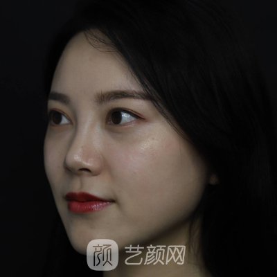 江门华美整形医院做鼻子怎么样？2022热门实例分享