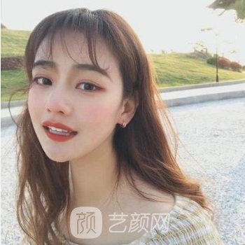 沈阳杏林张莹莹双眼皮实例，术后五官比例得到增强