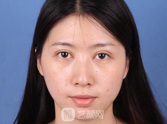 永州博美整形美容医院割双眼皮怎么样？2022招牌实例曝光