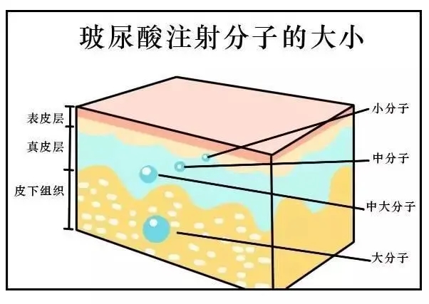 注射玻尿酸去除皱纹见效需要多长时间？