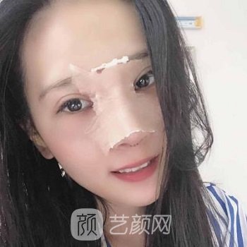 薛轶群做鼻子怎么样？隆鼻实例对比图，超A美女