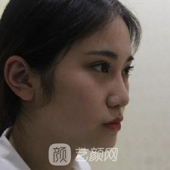 长沙熊宜文鼻修复实例，术后重获自信与美丽