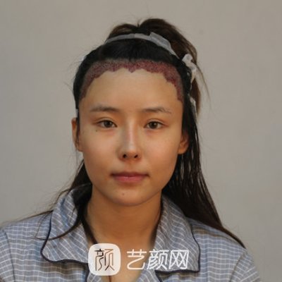 衡水唯美整形医院发际线种植实例出炉｜内附体验成果图