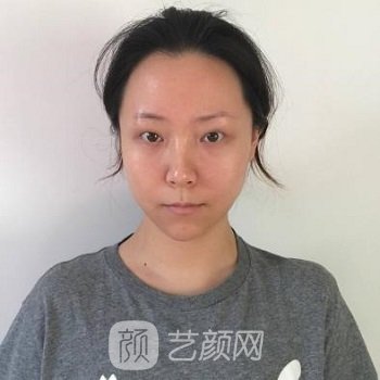 丁合军整形双眼皮实例，美丽眼部形态，轻松拥有