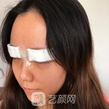 丁合军整形双眼皮实例，美丽眼部形态，轻松拥有