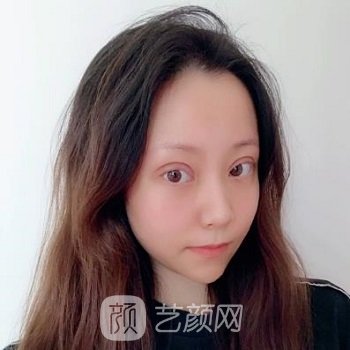 丁合军整形双眼皮实例，美丽眼部形态，轻松拥有