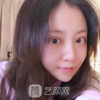 丁合军整形双眼皮实例，美丽眼部形态，轻松拥有