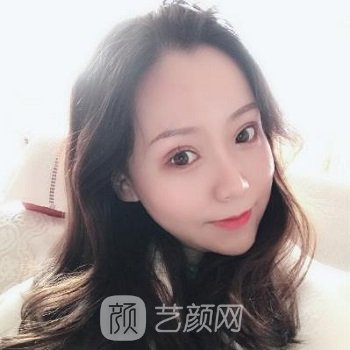 丁合军整形双眼皮实例，美丽眼部形态，轻松拥有