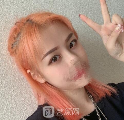欧阳春医生鼻整形失败修复实例，术后“妈生款”鼻子惊艳到我