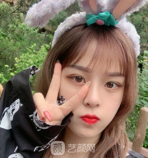 欧阳春医生鼻整形失败修复实例，术后“妈生款”鼻子惊艳到我
