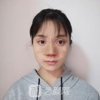 北京友谊医院整形科陈凤超医生怎么样？简介+隆鼻实例
