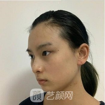 北京八大处李强医生简介双眼皮整形实例，附价格表