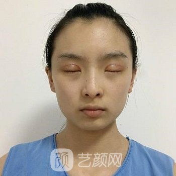 北京八大处李强医生简介双眼皮整形实例，附价格表