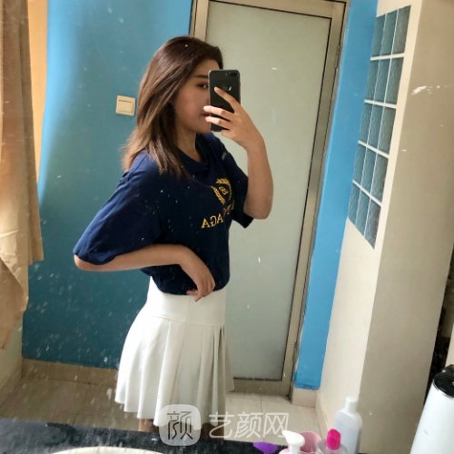 苏州美莱整形医院腰腹环吸实例公开｜内附体验前后对比图