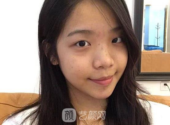 苏州美莱医院张亮割双眼皮实例曝光｜90天体验成果图集中一览