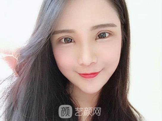 苏州美莱医院张亮割双眼皮实例曝光｜90天体验成果图集中一览