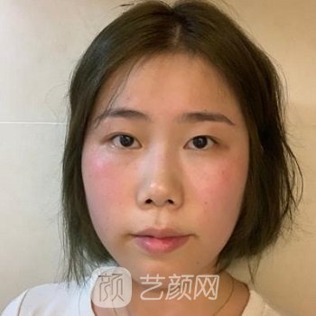 永康胡曙春医生双眼皮整形实例，塑造一双美眼有多简单