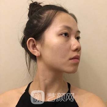 广州特壹美医疗美容做鼻子怎么样？附真人隆鼻实例对比图片