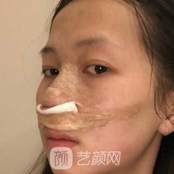 广州特壹美医疗美容做鼻子怎么样？附真人隆鼻实例对比图片