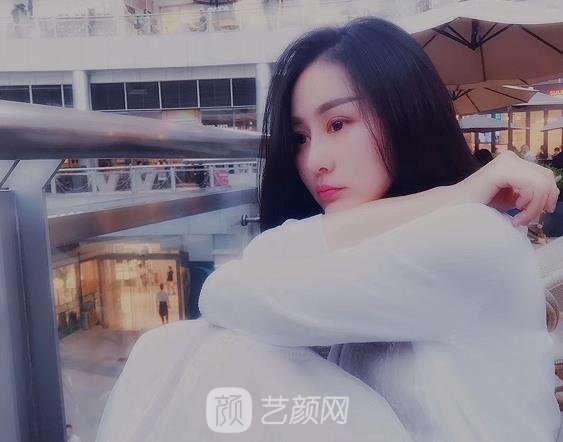 石家庄美联臣翟彦刚双眼皮实例公开｜附90天修复成果图